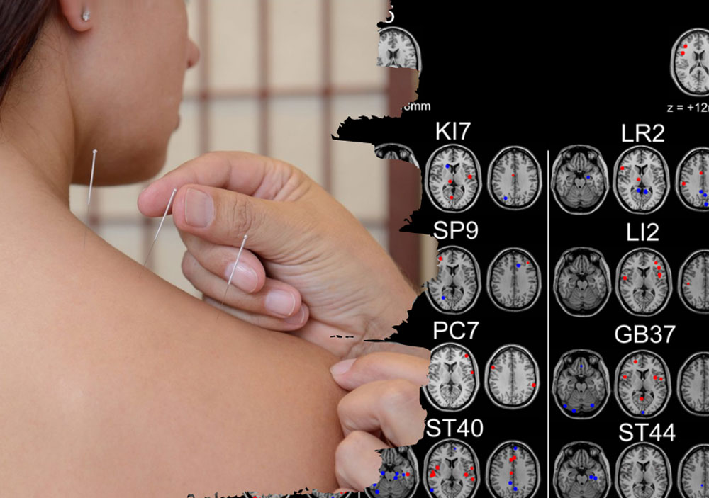 post-acupuncture2
